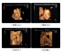 贵港四维彩超去哪里好？贵港牡丹妇产医院高清四维彩超